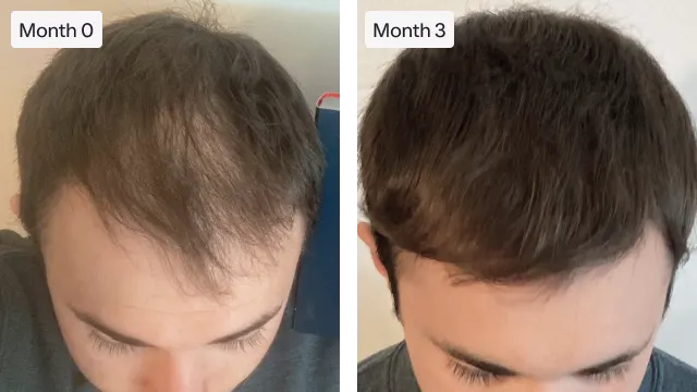 Topical finasteride: a fresh approach for those looking for hair restoration